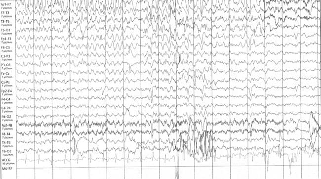 Scansione cerebrale anomala con attività epilettiforme focale